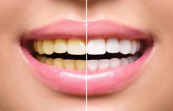 What Causes Yellow Teeth? 5 Possibilities Philadelphia PA Dentist