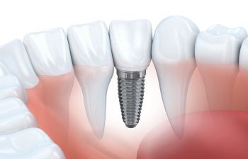 Do You Believe These 5 Myths About Dental Implants? Philadelphia PA Dentist